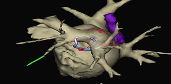 Ablación percutánea de la fibrilación auricular