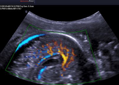 Malformaciones cerebrales