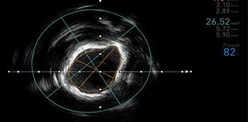 Sistemas de diagnóstico intracoronario