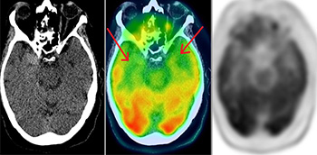 PET/TAC y PET/RM en demencias