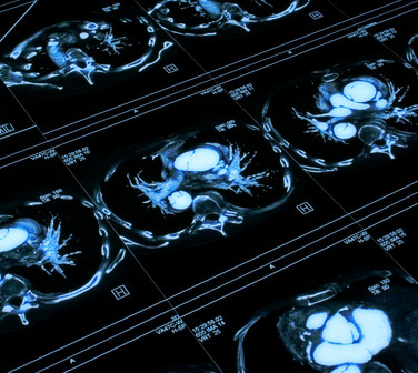 Miocardiopatías en RM