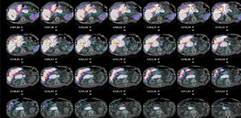 Radioembolización de las metástasis hepáticas