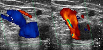 Rama_anterolateral_ectasica_h_1