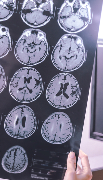 Plan de cuidados: ICTUS