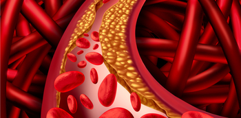 Actualización sobre el tratamiento de la dislipemia