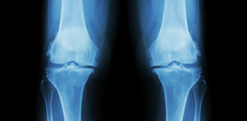 Artrografía, Artroct y Artrorm