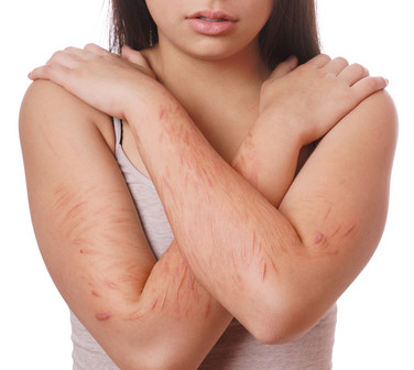 Autolesiones no suicidas en los TCA