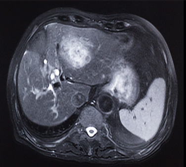 Metástasis hepáticas en cáncer colorrectal