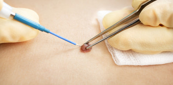 Diagnóstico-terapeútica del carcinoma basocelular