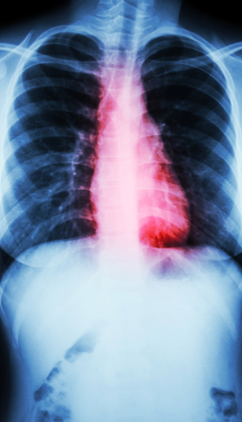 Plan de cuidados: cardiopatía isquémica
