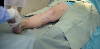 Esclerosis de varices