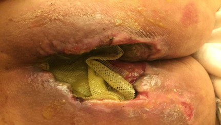 Úlcera por presión