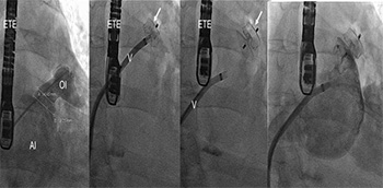 Cierre percutáneo de orejuela izquierda