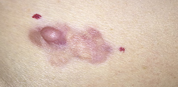 Dermatofibrosarcoma protuberans