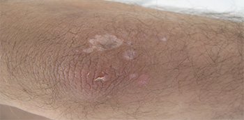 Esclerodermia y síndromes esclerodermiformes