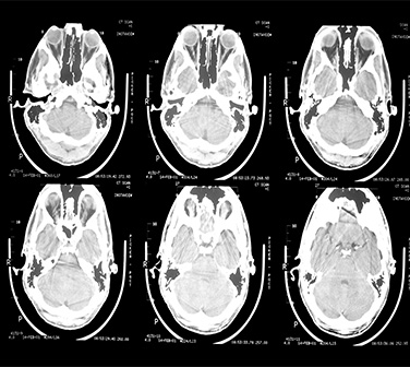 Concepto de esquizofrenia