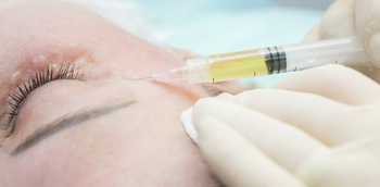 Extracción ecoguiada de polialquilimida