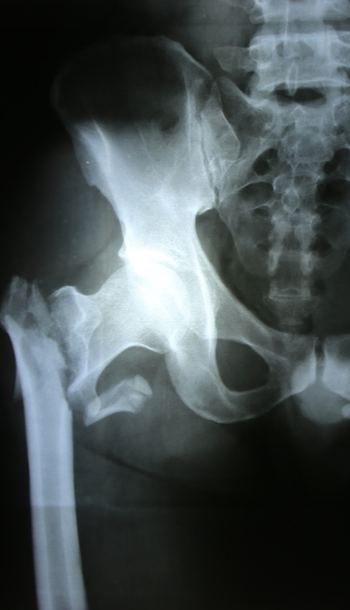 Plan de cuidados: fractura de cadera