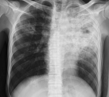 Insuficiencia cardiaca