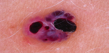 1ª ed. Dermatoscopia