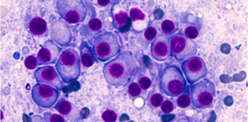 Seguimiento del paciente con MM en recaída o refractario