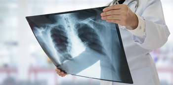 Neumonia adquirida comunidad