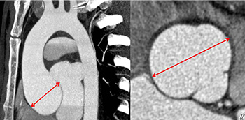 Valoración y manejo de la patología de la raíz aórtica