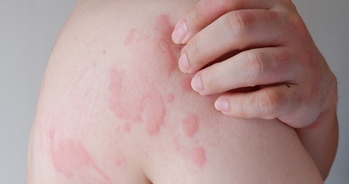 Actualización en dermatitis de contacto y alergia cutánea (Basado en las III Jornadas de Formación)