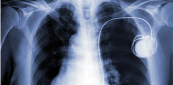 Terapia de resincronización cardiaca