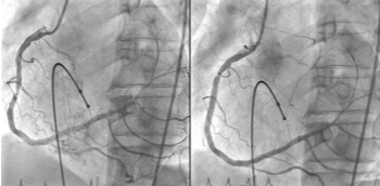 Tratamiento antiagregante y anticoagulante en intervencionismo percutáneo coronario y estructural
