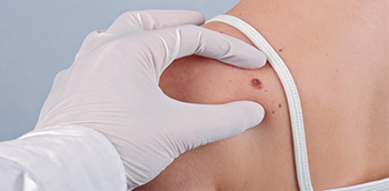 Ecografía cutánea en tumor glómico