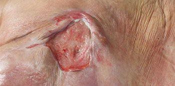 PC Úlceras por presión II