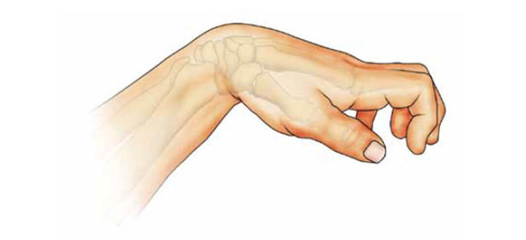 Conceptos generales y abordaje multidisciplinar de la espasticidad