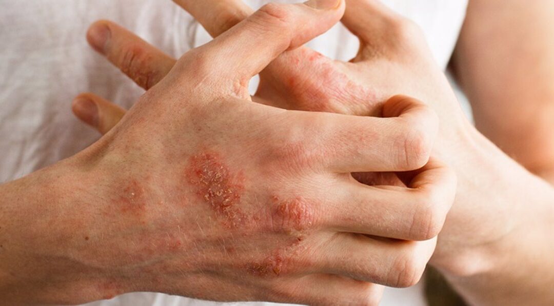 Actualización Esclerodermia y síndromes esclerodermiformes